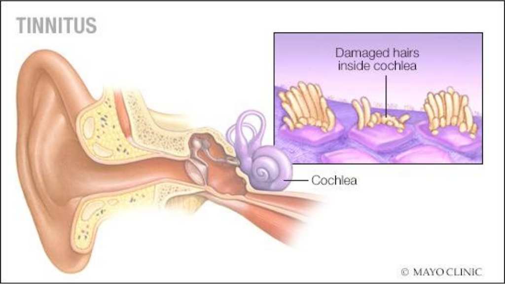 natural tinnitus treatment